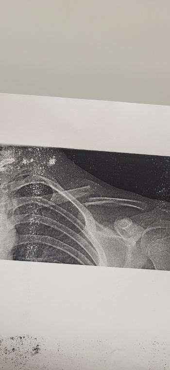 That's the broken clavicle 